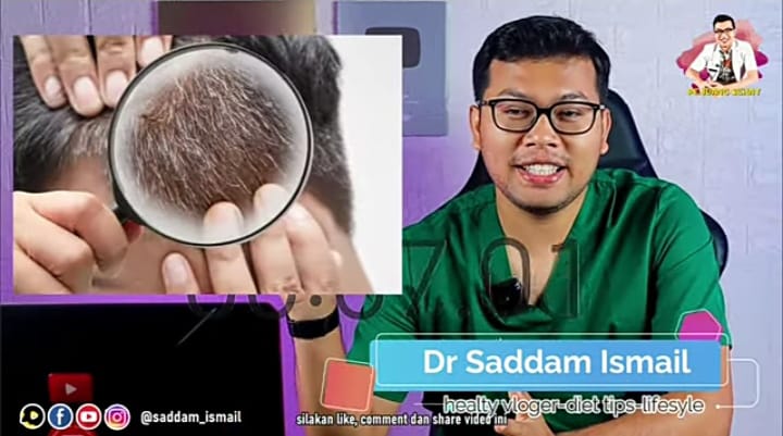 Usia Muda Sudah Timbul Uban di Kepala, Ini Penjelasannya Menurut dr. Saddam Ismail